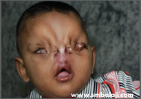 After cleft lip and palate surgery