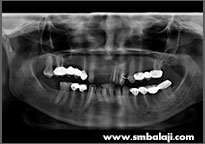 Digital X-ray showing cyst lesions