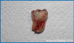 Impacted wisdom tooth surgically removed atraumatically