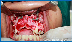 Le Fort I maxillary osteotomy