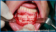 Mandibular segmental subapical osteotomy -  excess bone removal from left lower jaw to correct slanting bite