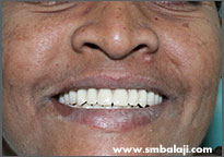 Patient wearing complete removable dentures