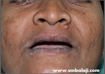 Patient with complete tooth loss