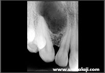 Radiovisuograph showing cyst lesion