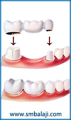 Schematic diagram of dental bridge