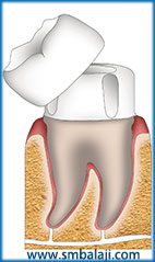 Schematic diagram of dental crown
