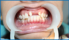 Teeth adjoining space of missing upper front teeth-prepared