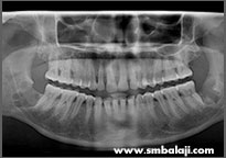  X-ray showing good bone healing after surgery