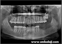 X-ray showing very good bone healing just three months following surgery