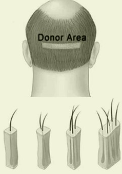 FUT or Strip Hair Transplant