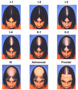 Female-Pattern-Hair-Loss
