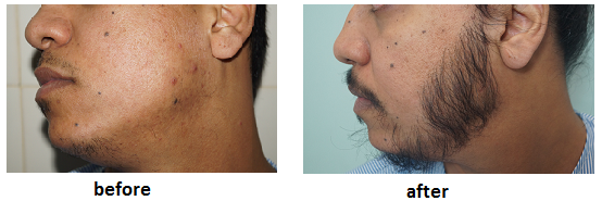 Facial Hair Transplant