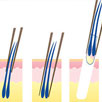 Follicular Unit Extraction(FUE)
