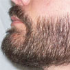 Beard/Moustache Transplant